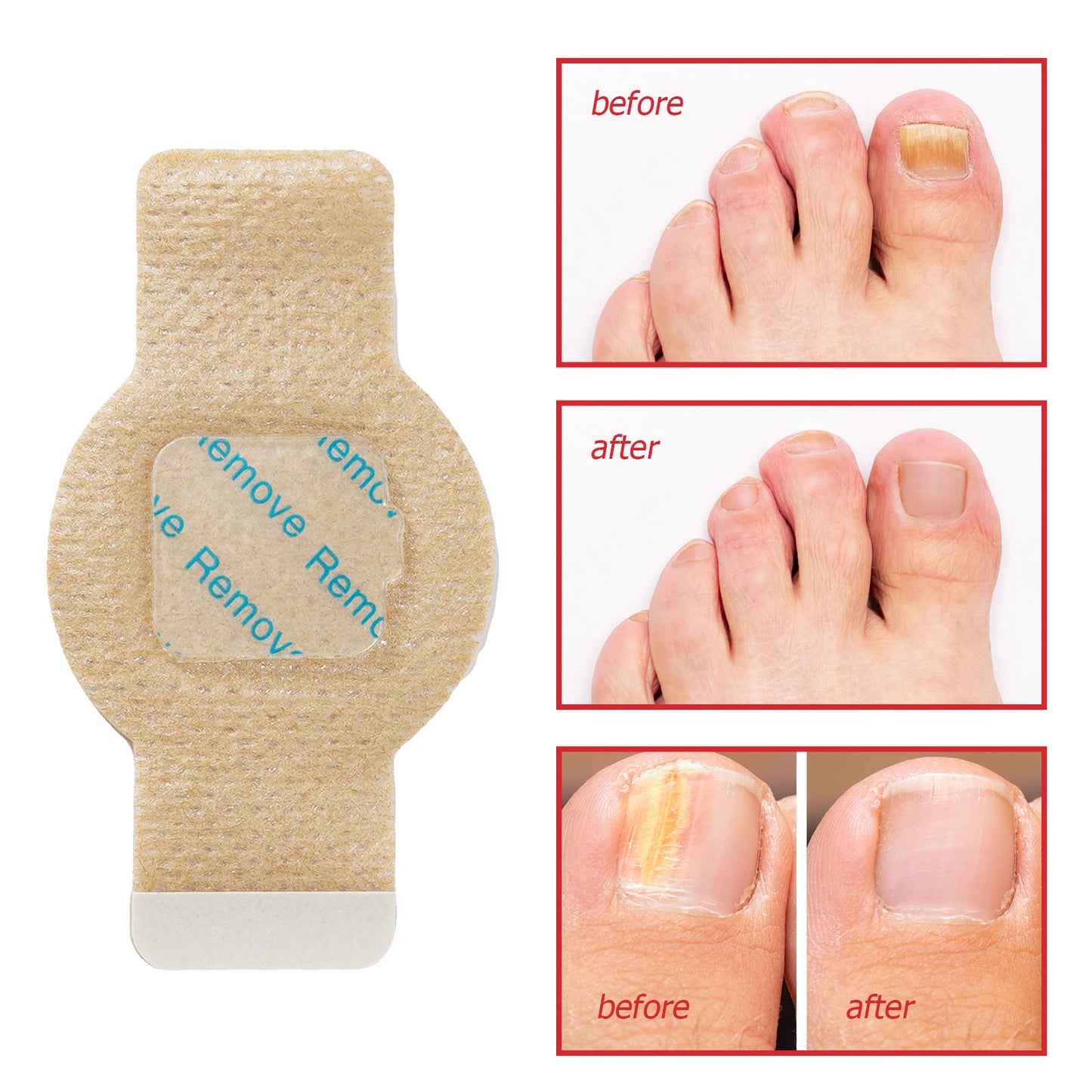 Antibacterial Nai Patches