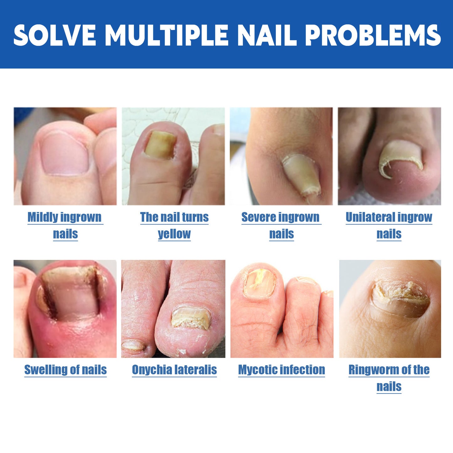 Nail Groove Nursing Adhesive Bandage