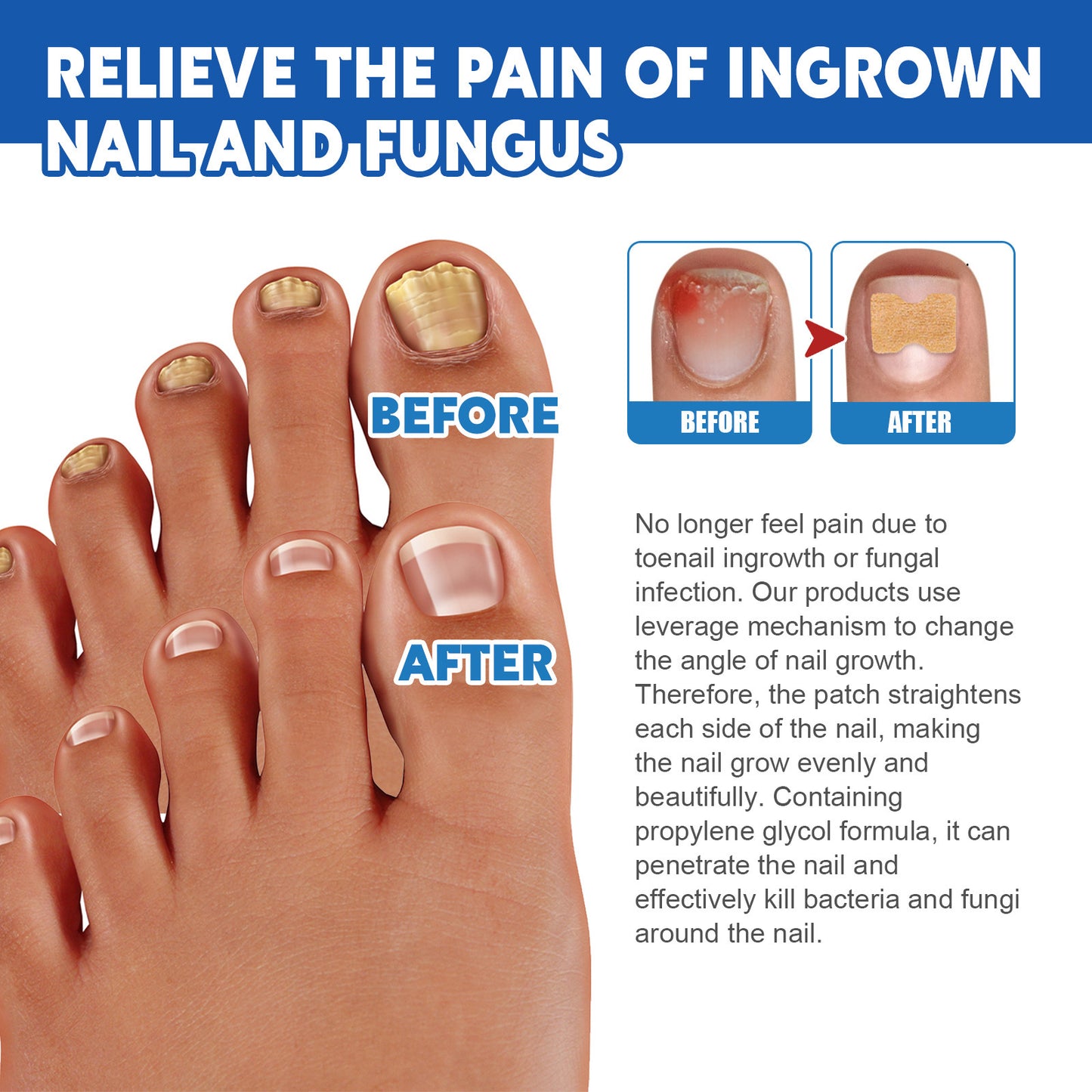 Nail Groove Nursing Adhesive Bandage